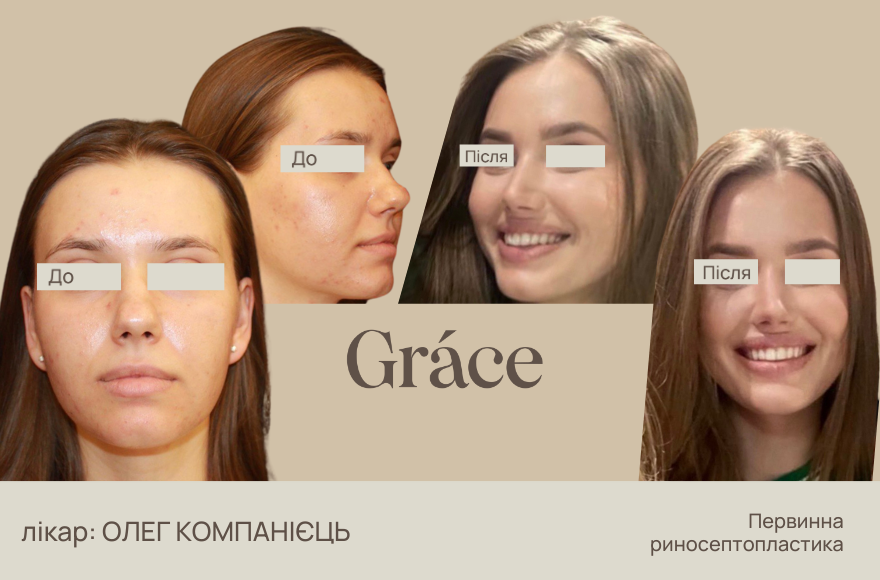 Ринопластика: до після