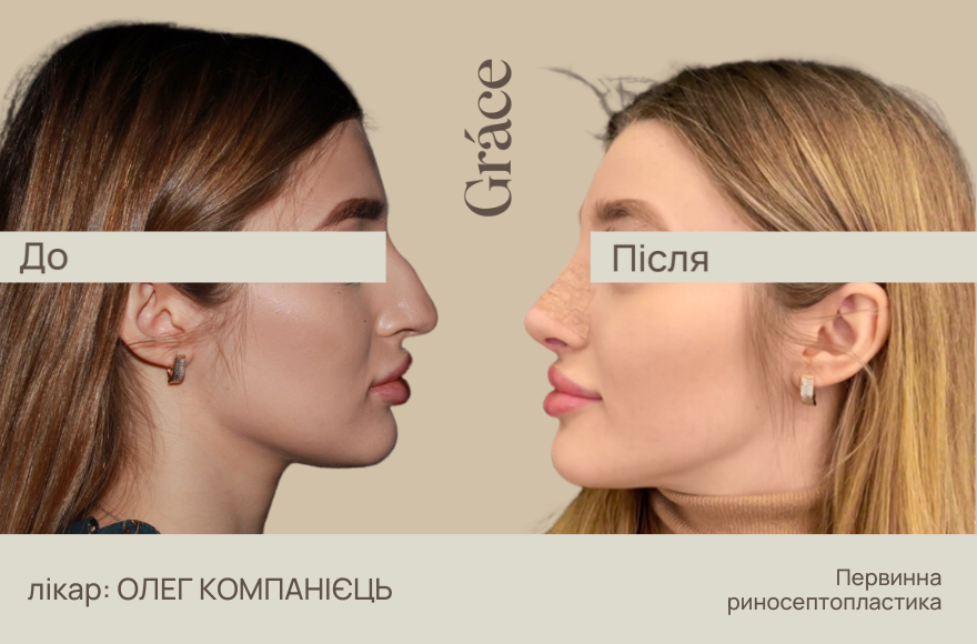Ринопластика: до після