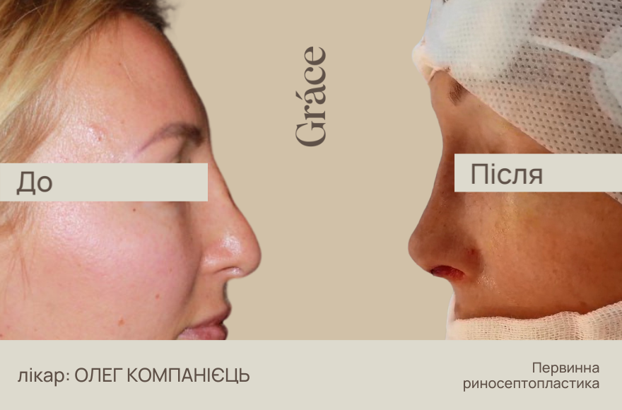 До / після хірурга