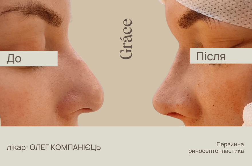 Ринопластика: до після