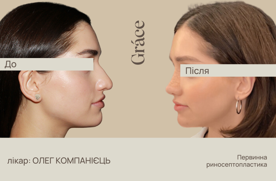 Ринопластика: до після