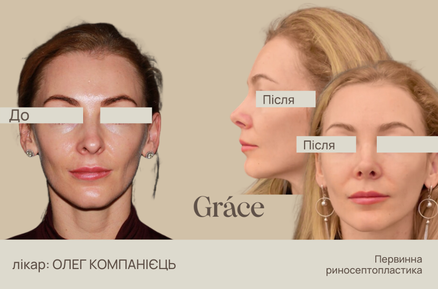 До / після хірурга