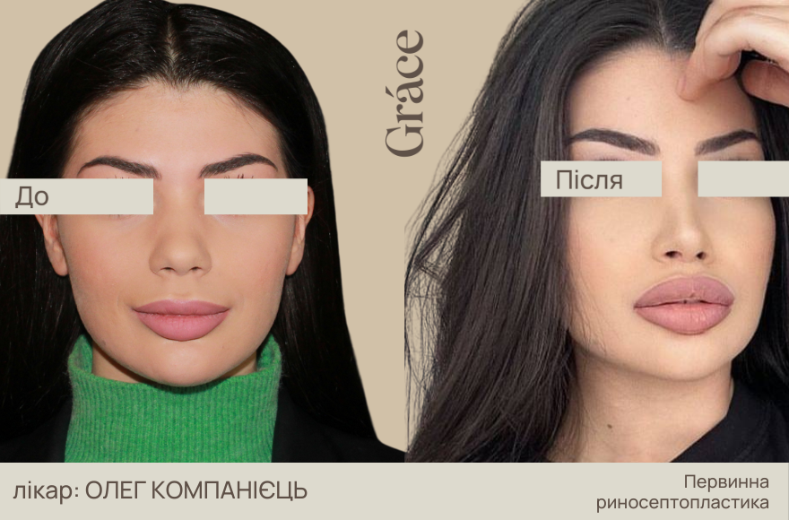До / після хірурга