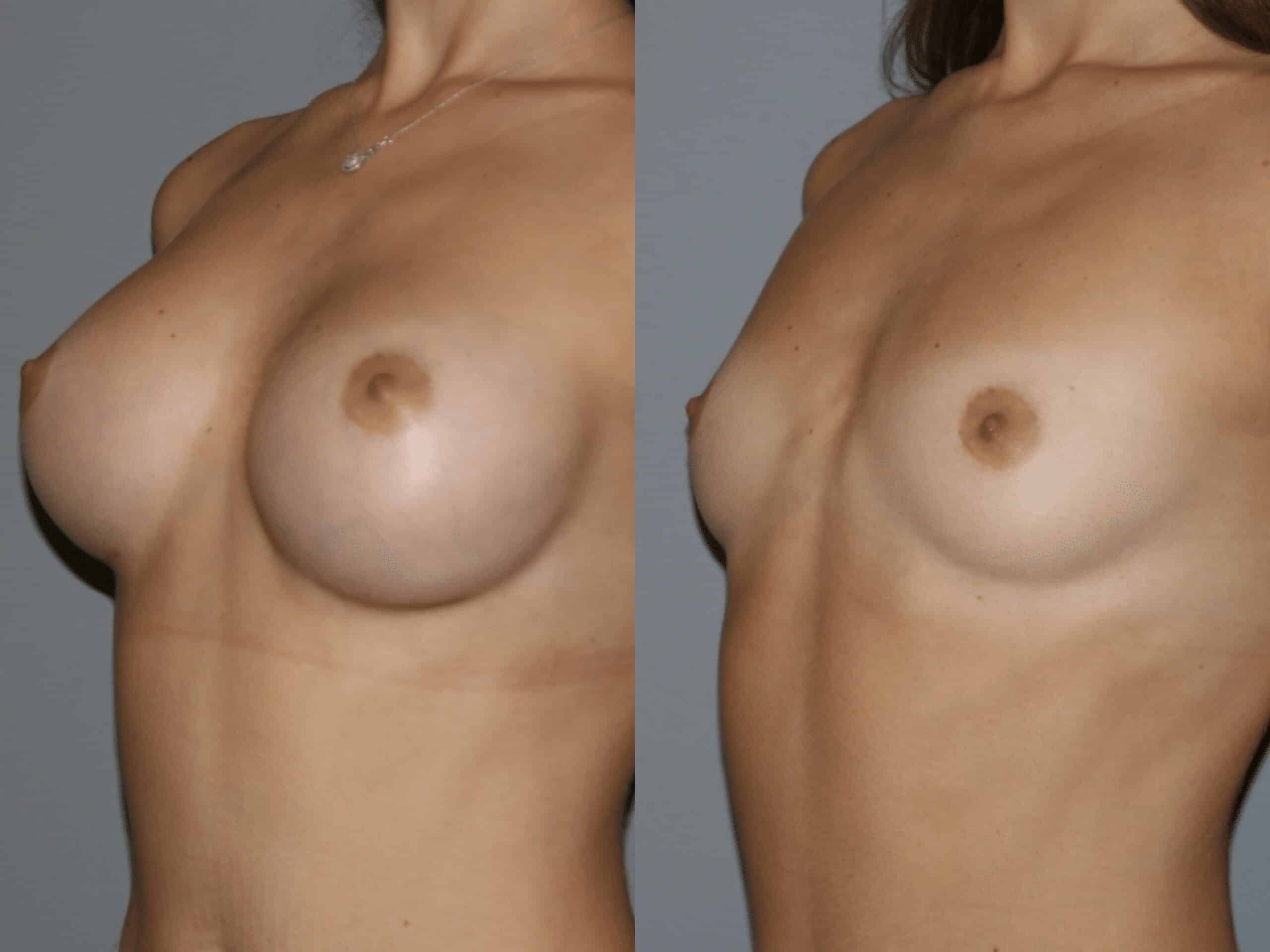 Маммопластика: до и после