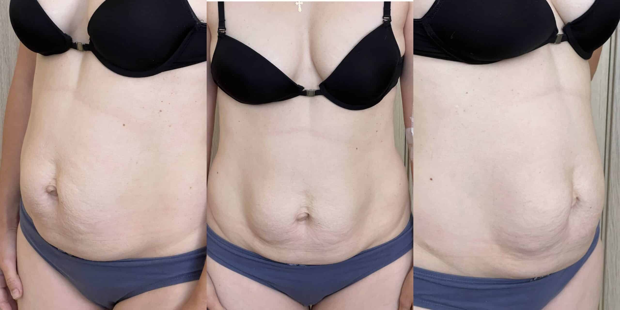 Абдомінопластика: до / після