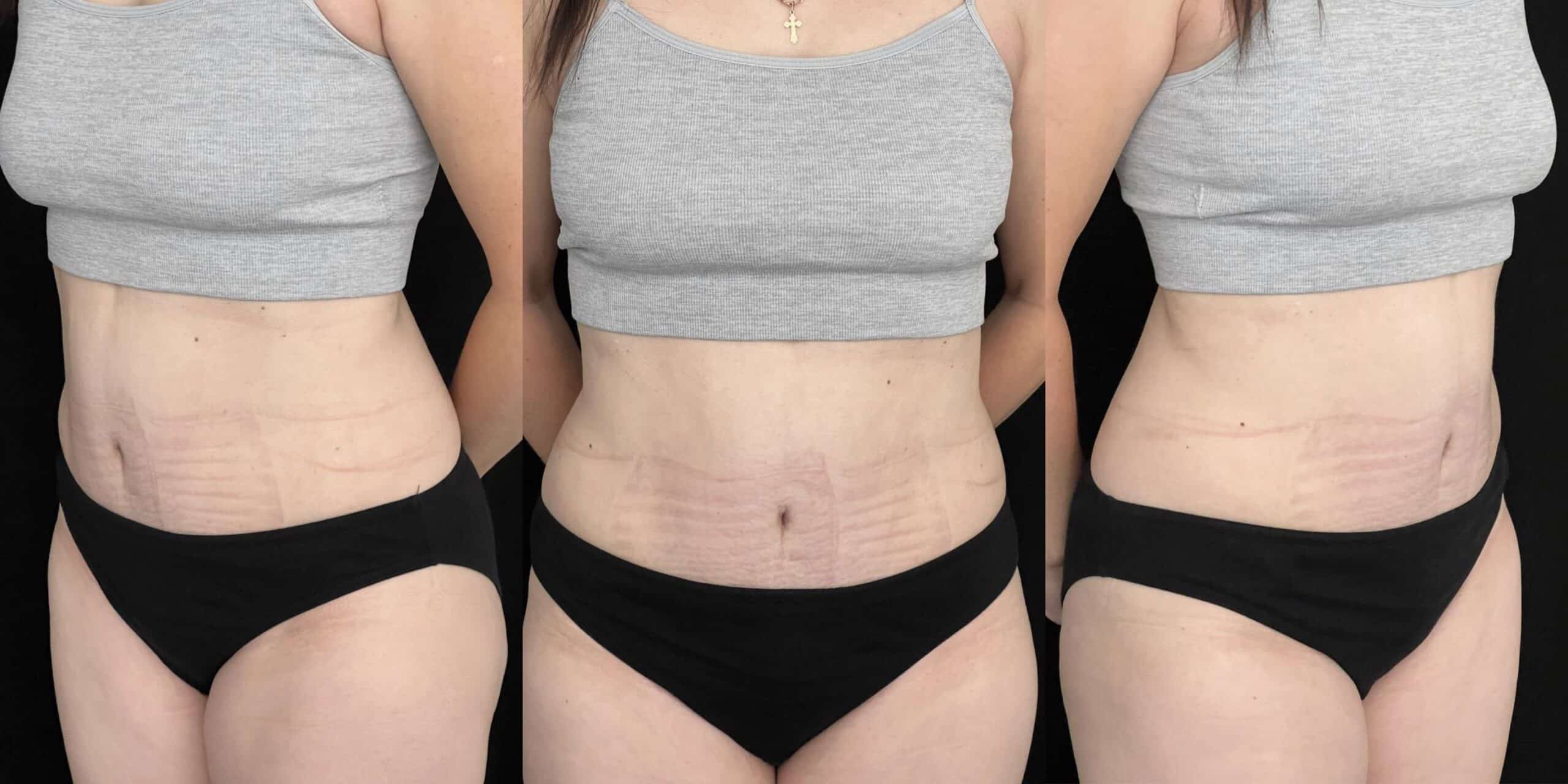 Бодилифтинг: до после