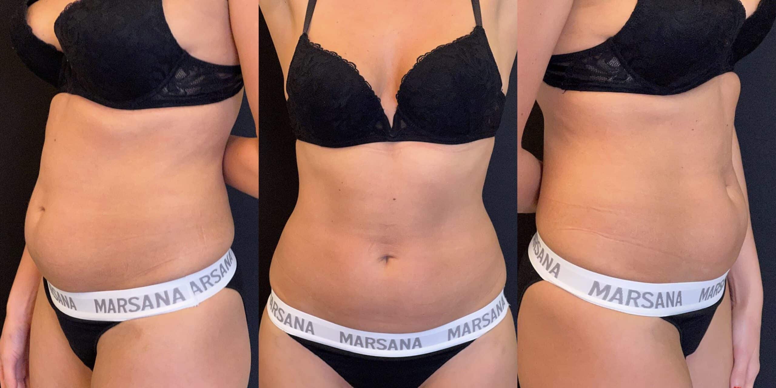 Абдомінопластика: до / після