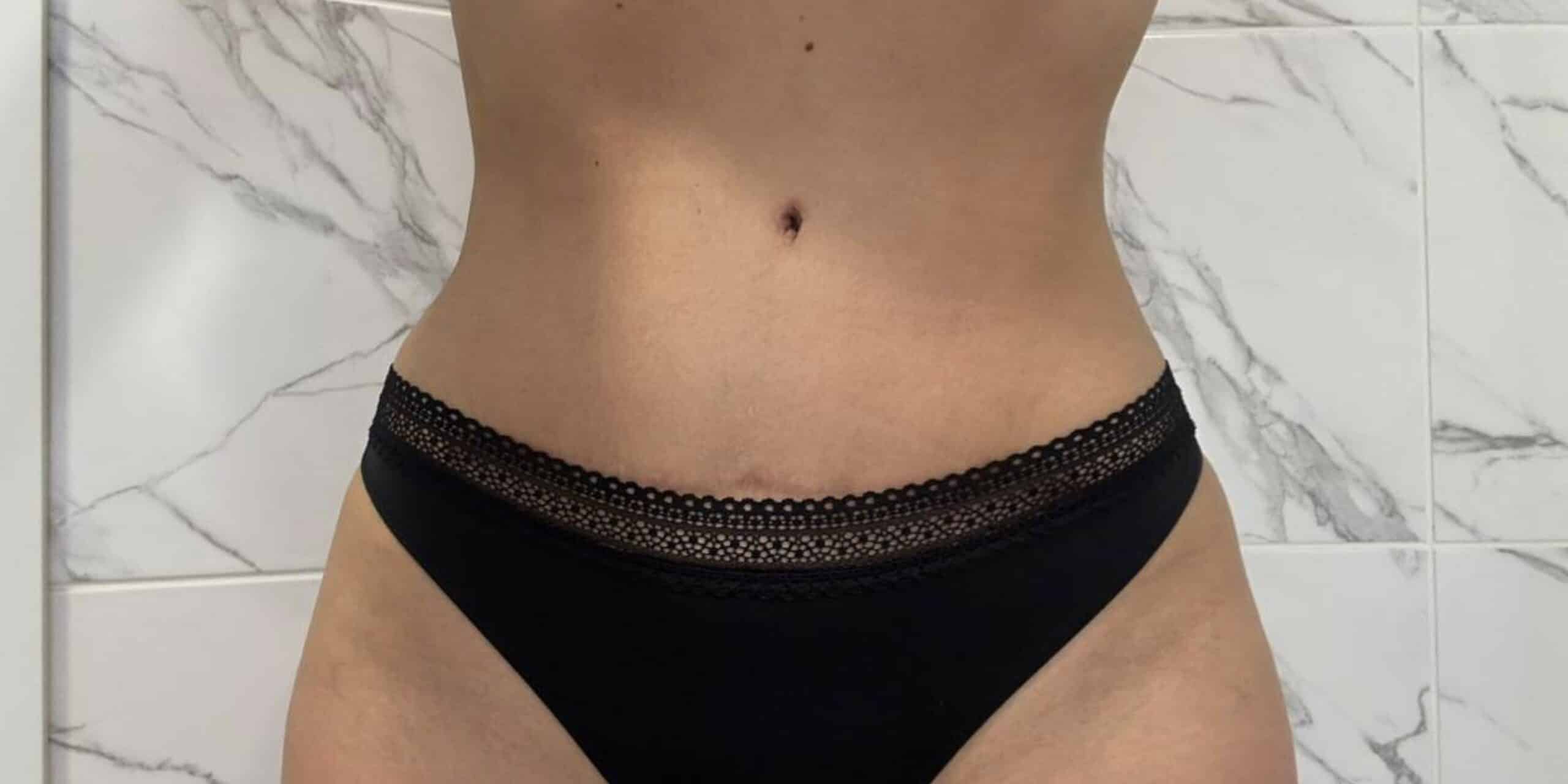 Абдомінопластика: до / після