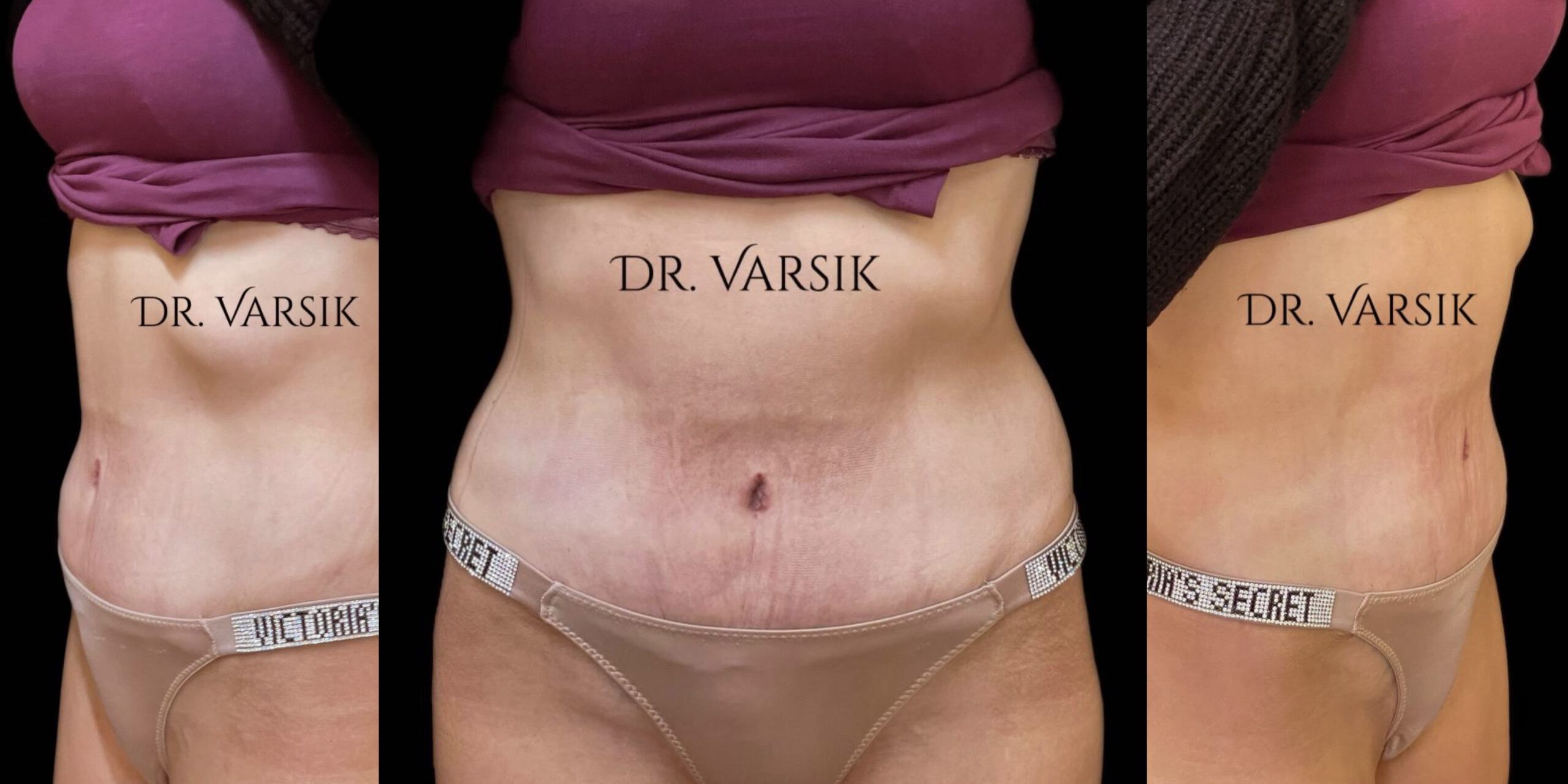 Абдомінопластика: до / після