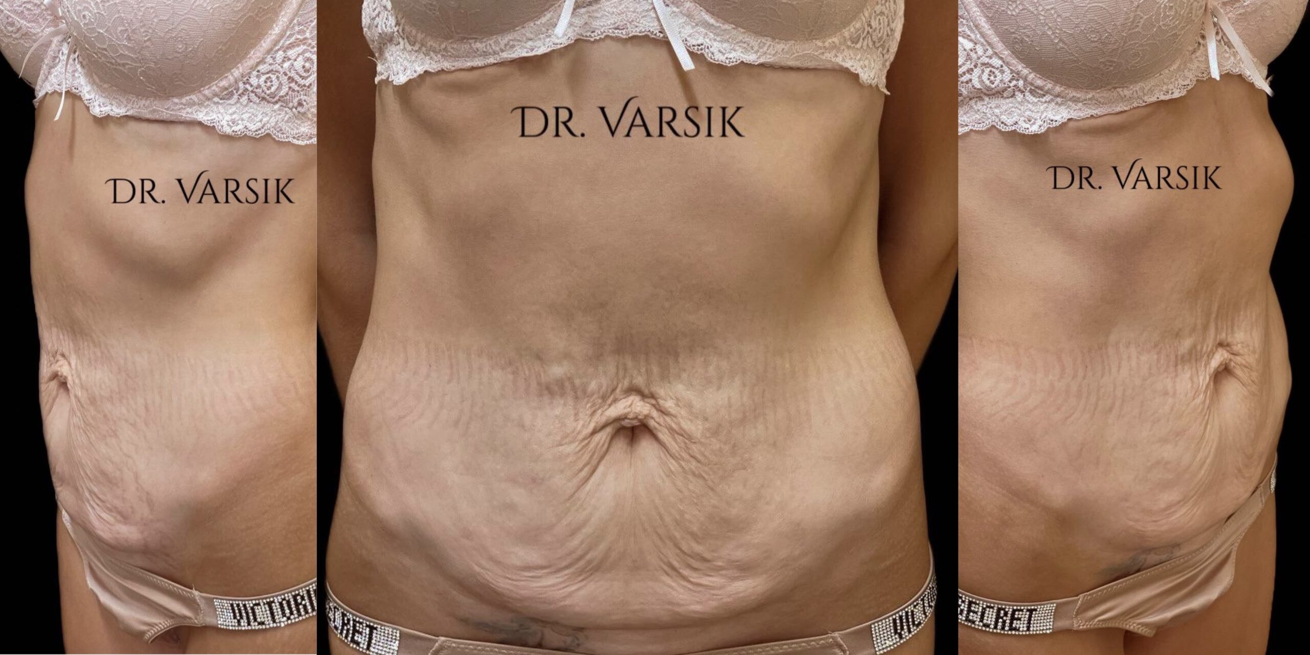 Абдомінопластика: до / після