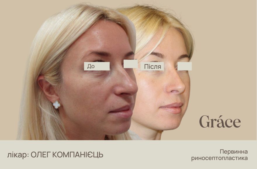 Ринопластика: до після