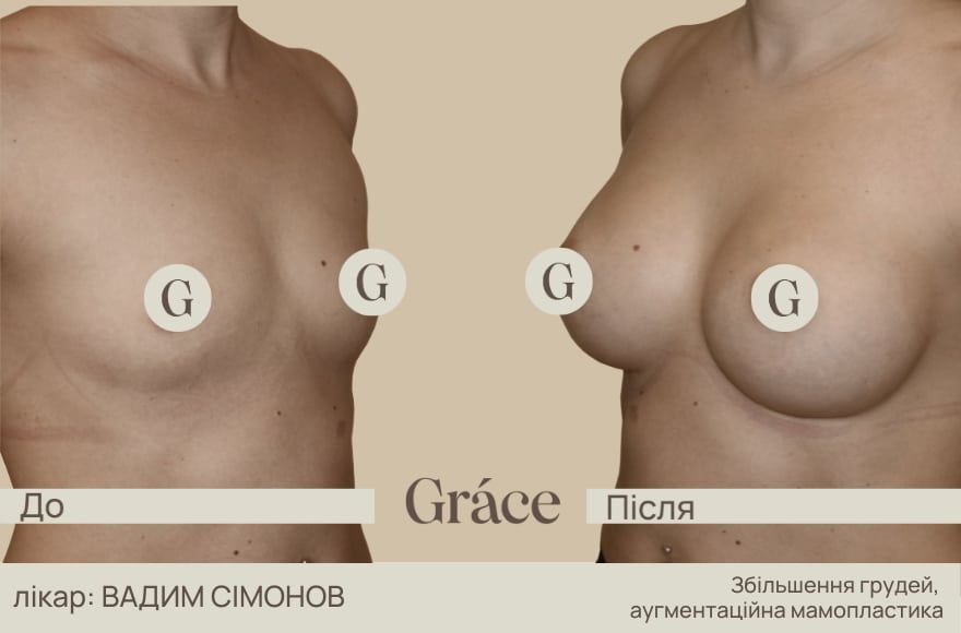 До / після хірурга