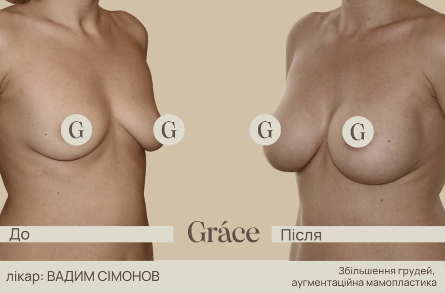 До / після хірурга