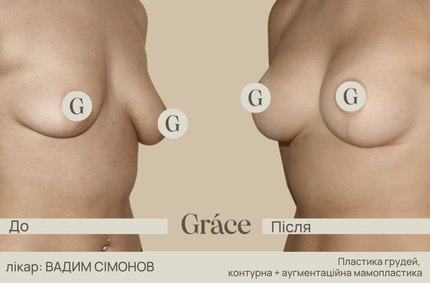 До / після хірурга