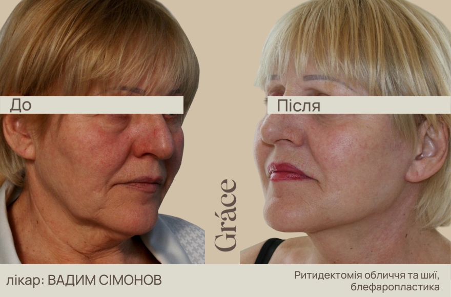 До / після хірурга