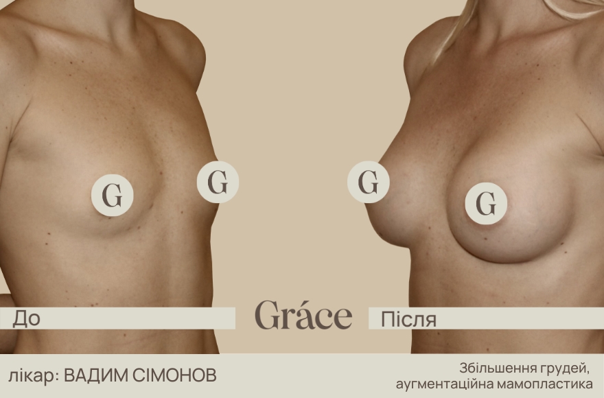 До / після хірурга