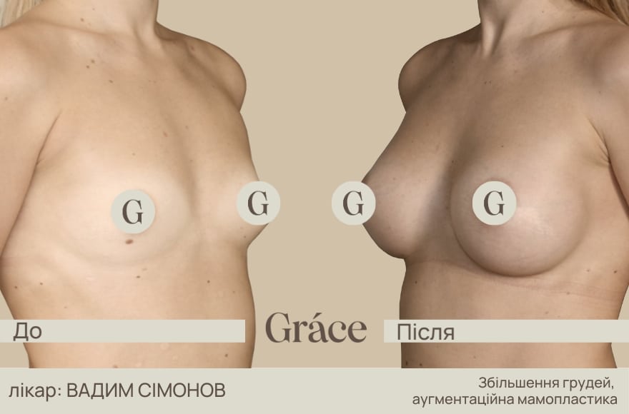 До / після хірурга