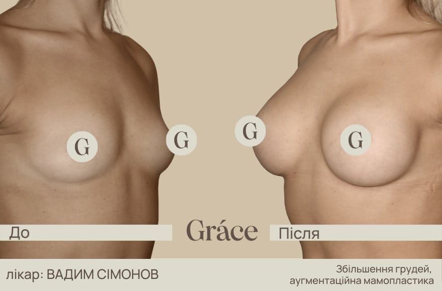 До / після хірурга