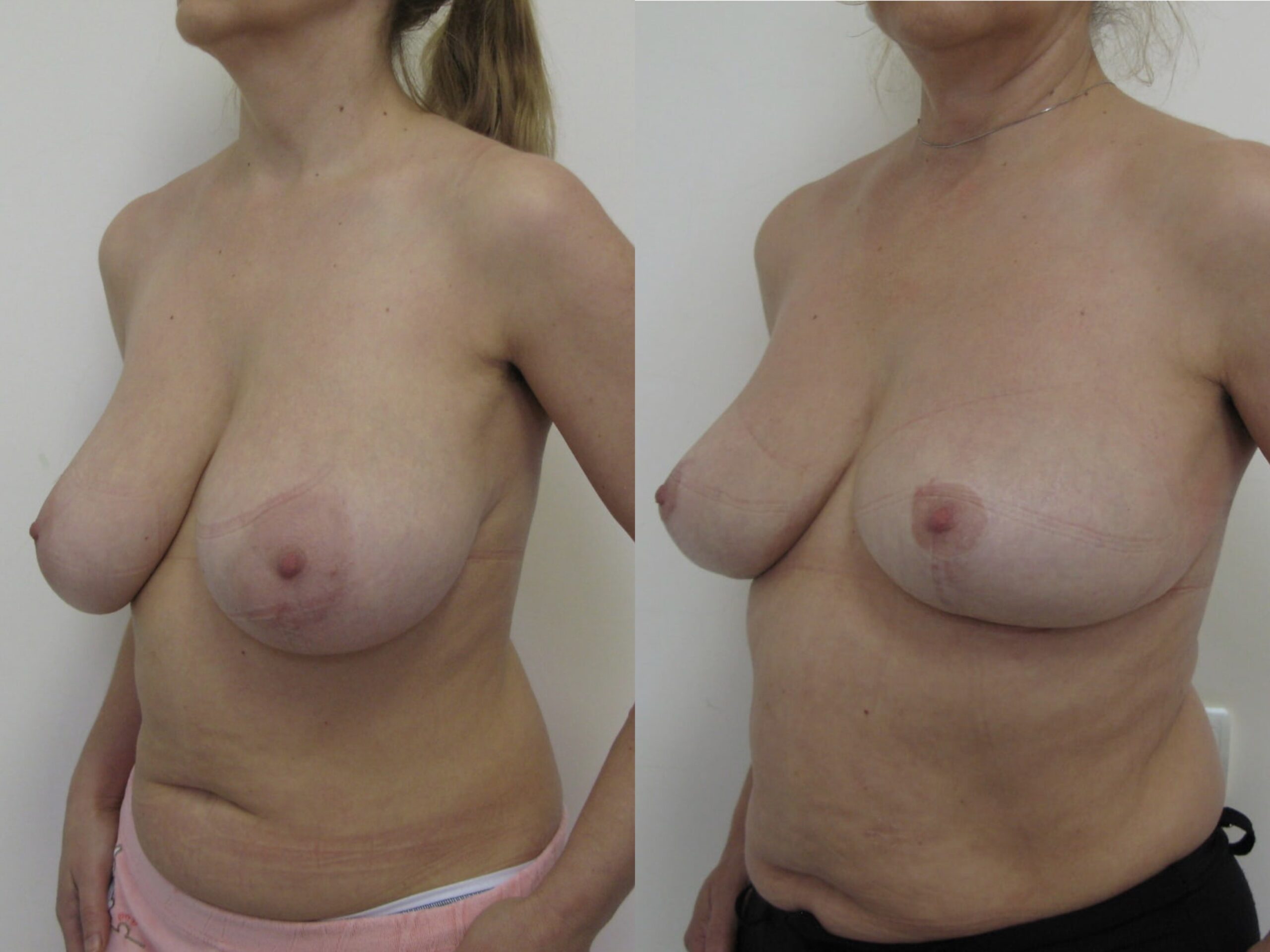 Уменьшение груди: до и после