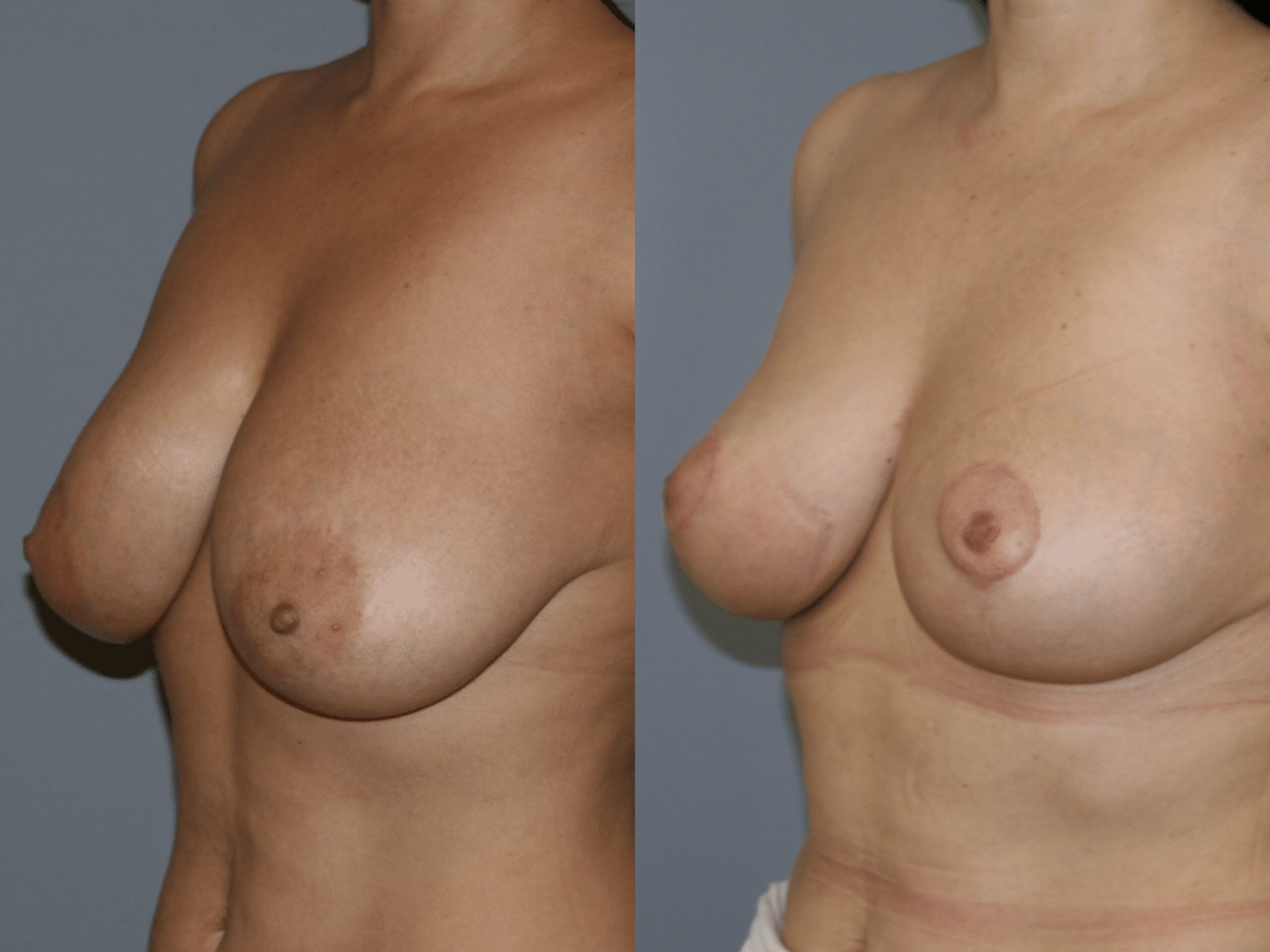 Уменьшение груди: до и после