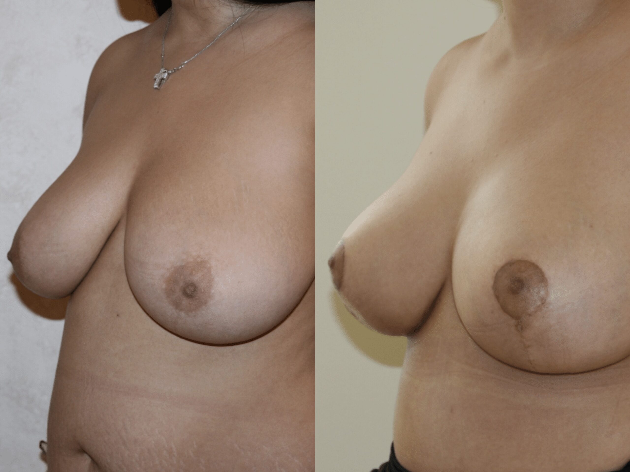 Уменьшение груди: до и после