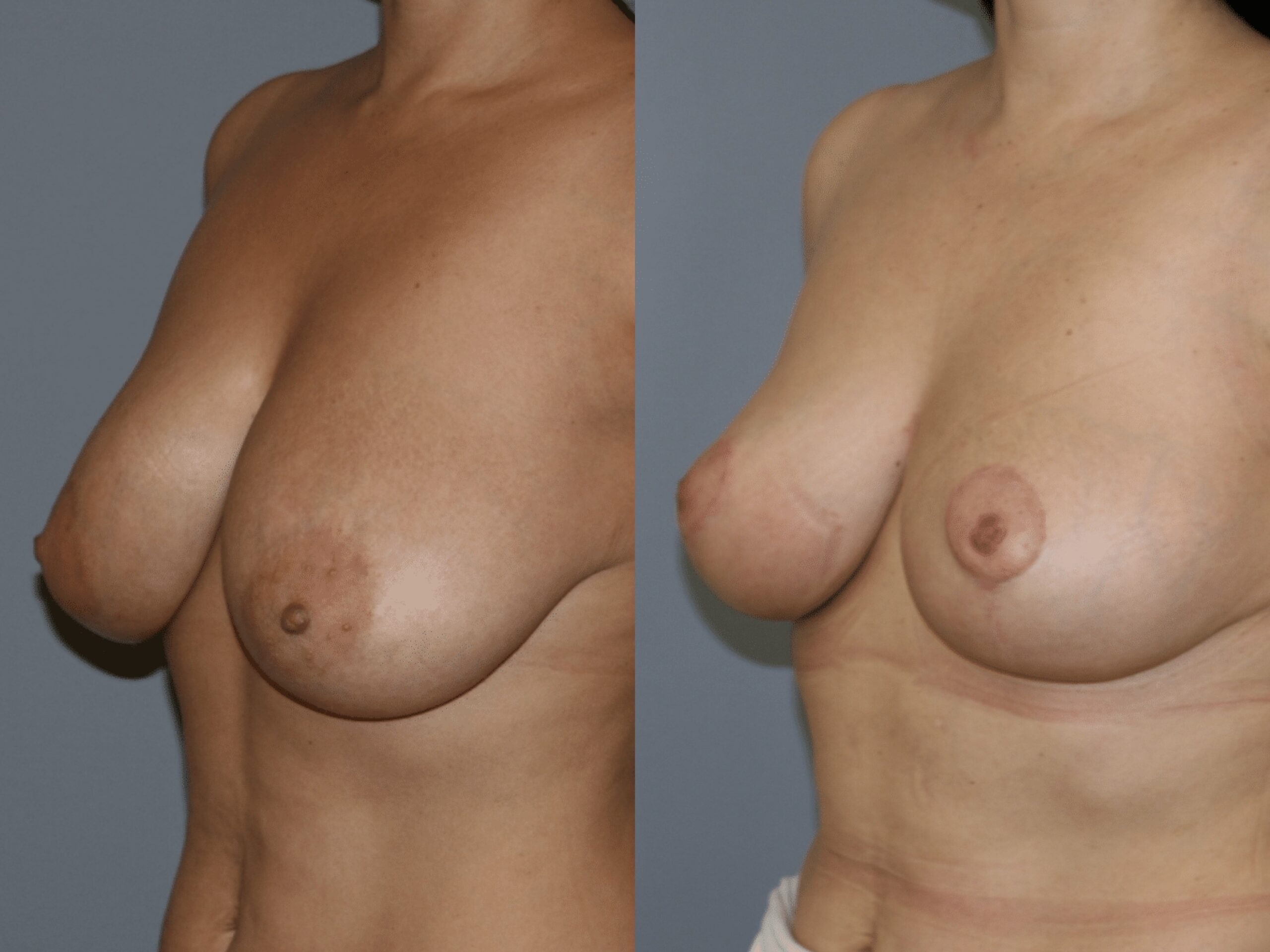 zmenshennya-grudey-kyiv