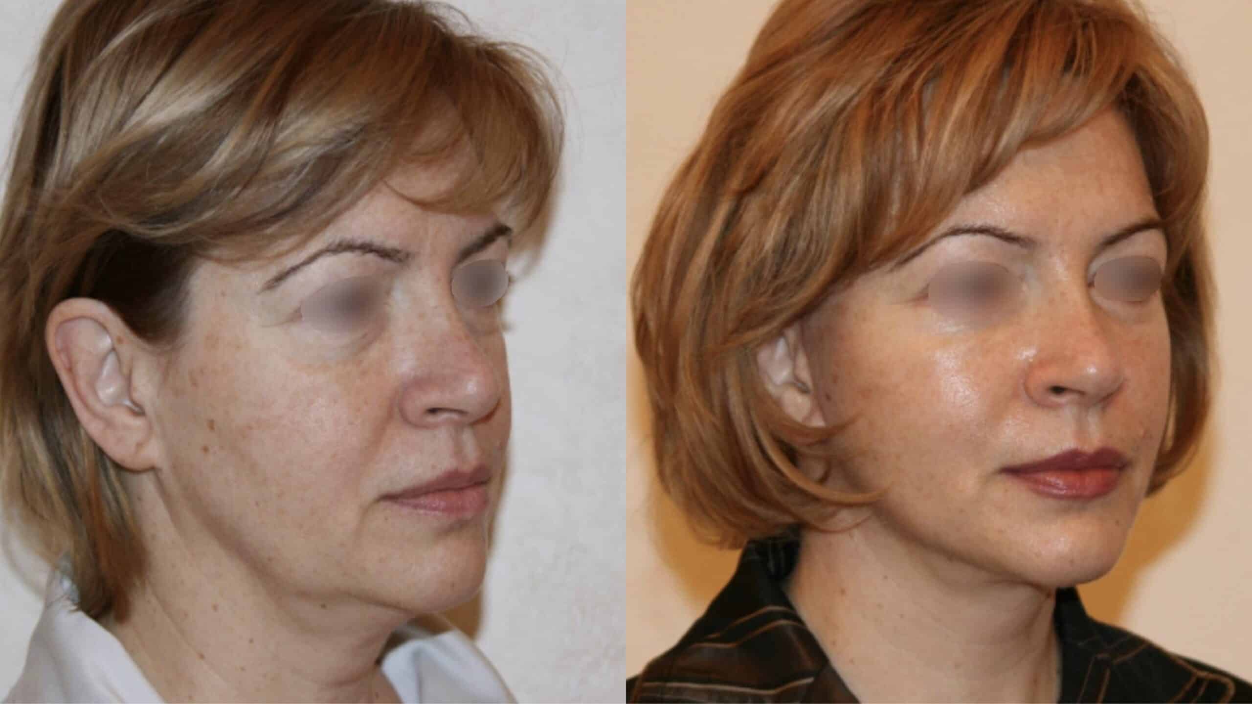 Платизмопластика: до после