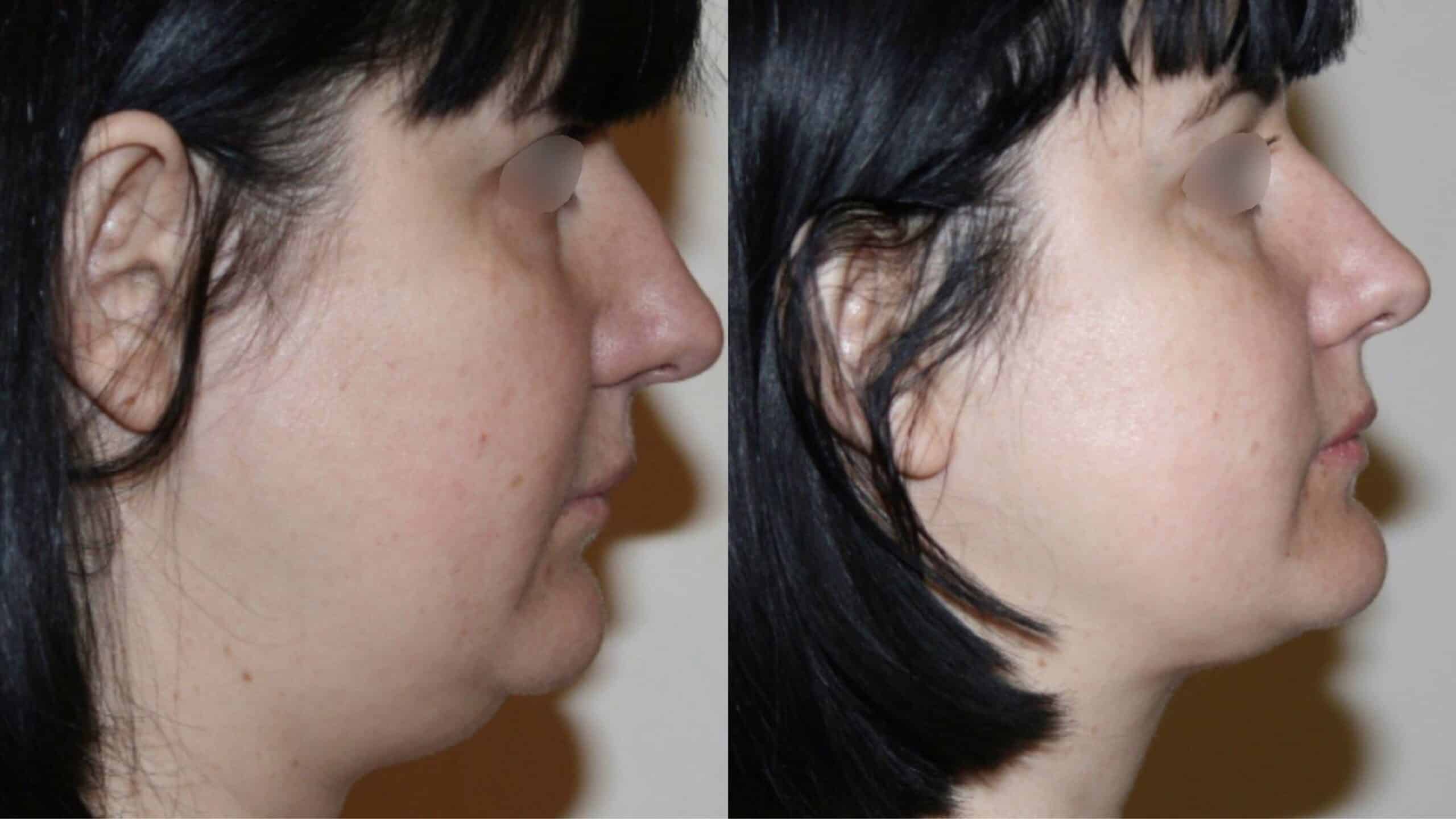 Платизмопластика: до после