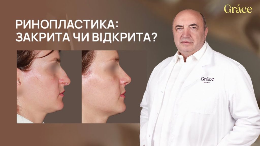 Ринопластика: закрита чи відкрита?