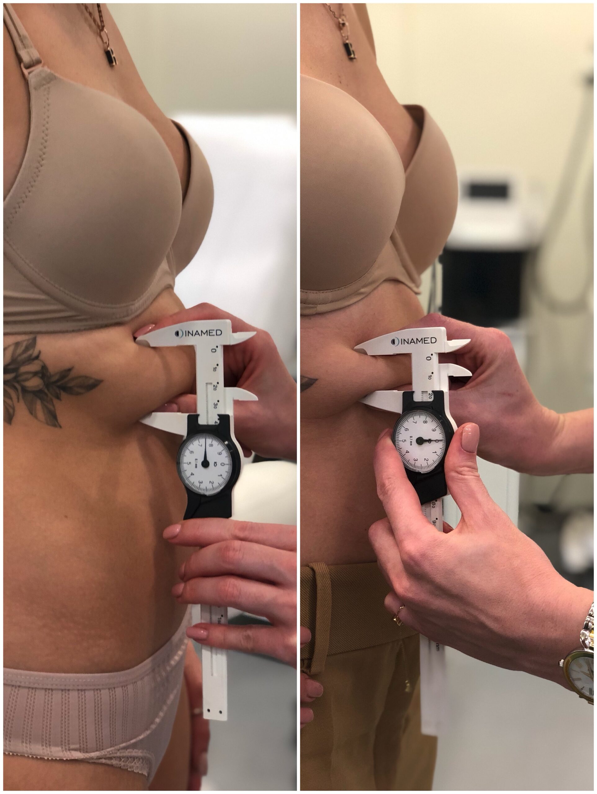 kriolipoliz-coolsculpting