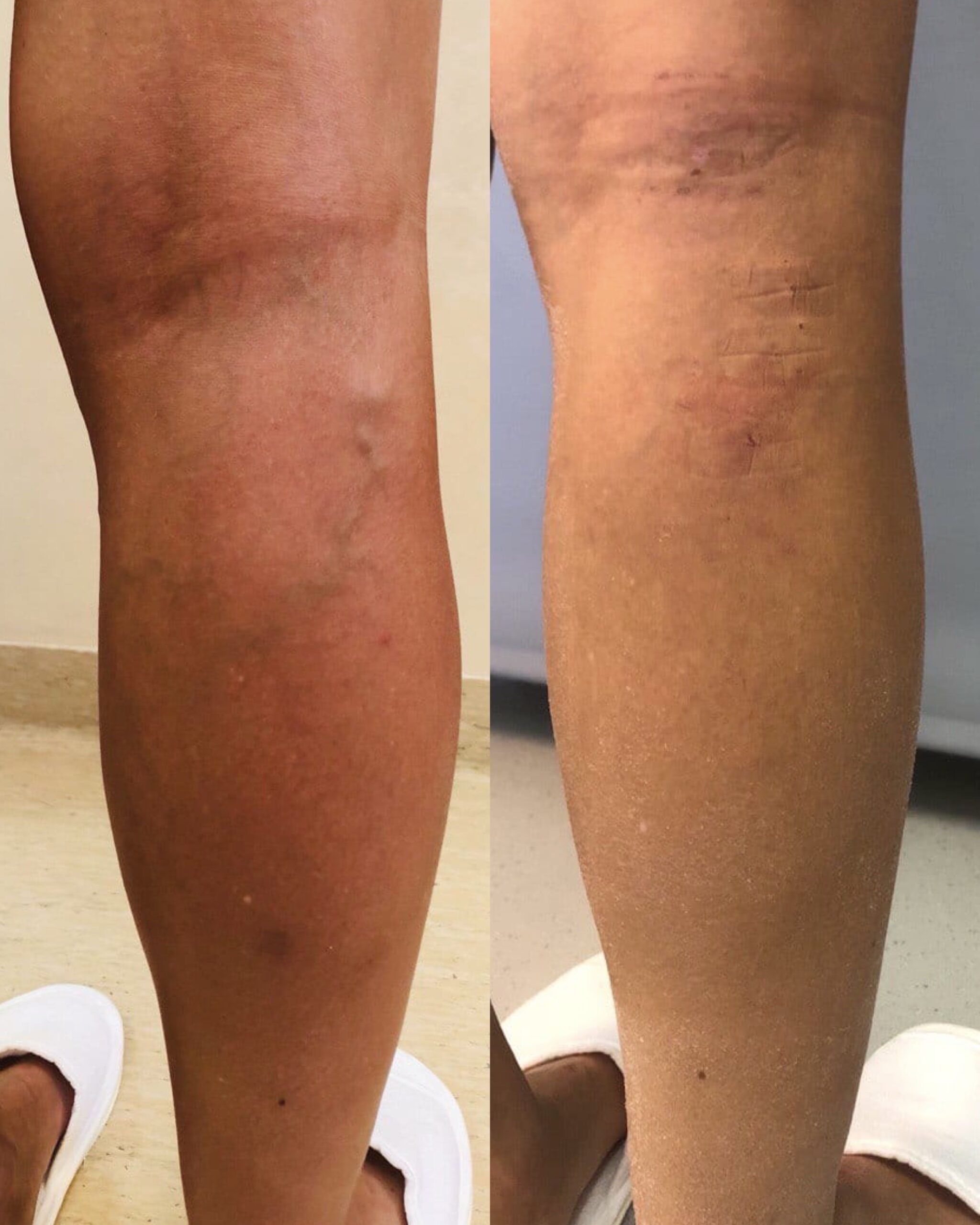 Клеевая облитерация вен: до после