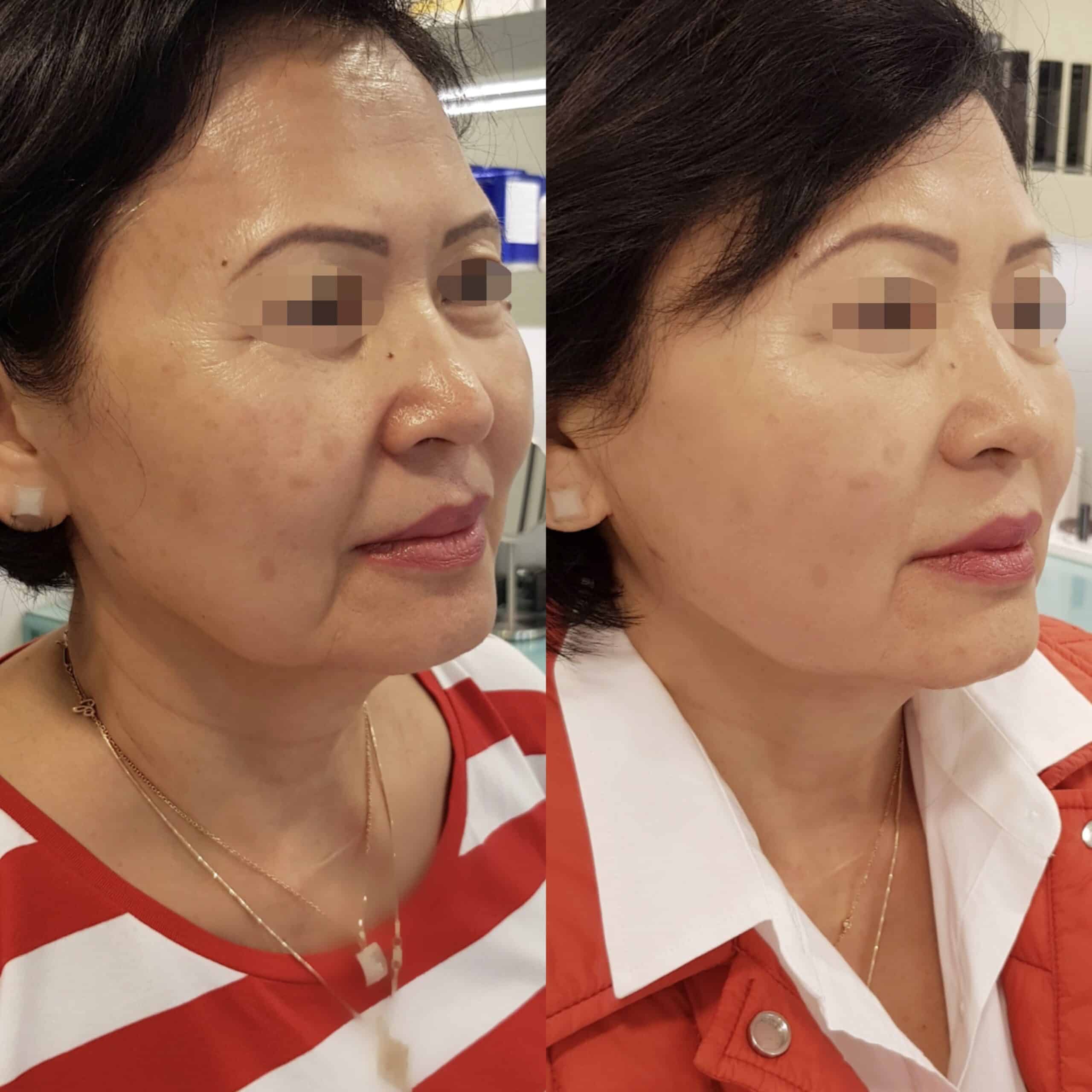 Смас ліфтинг ультраформер: до після