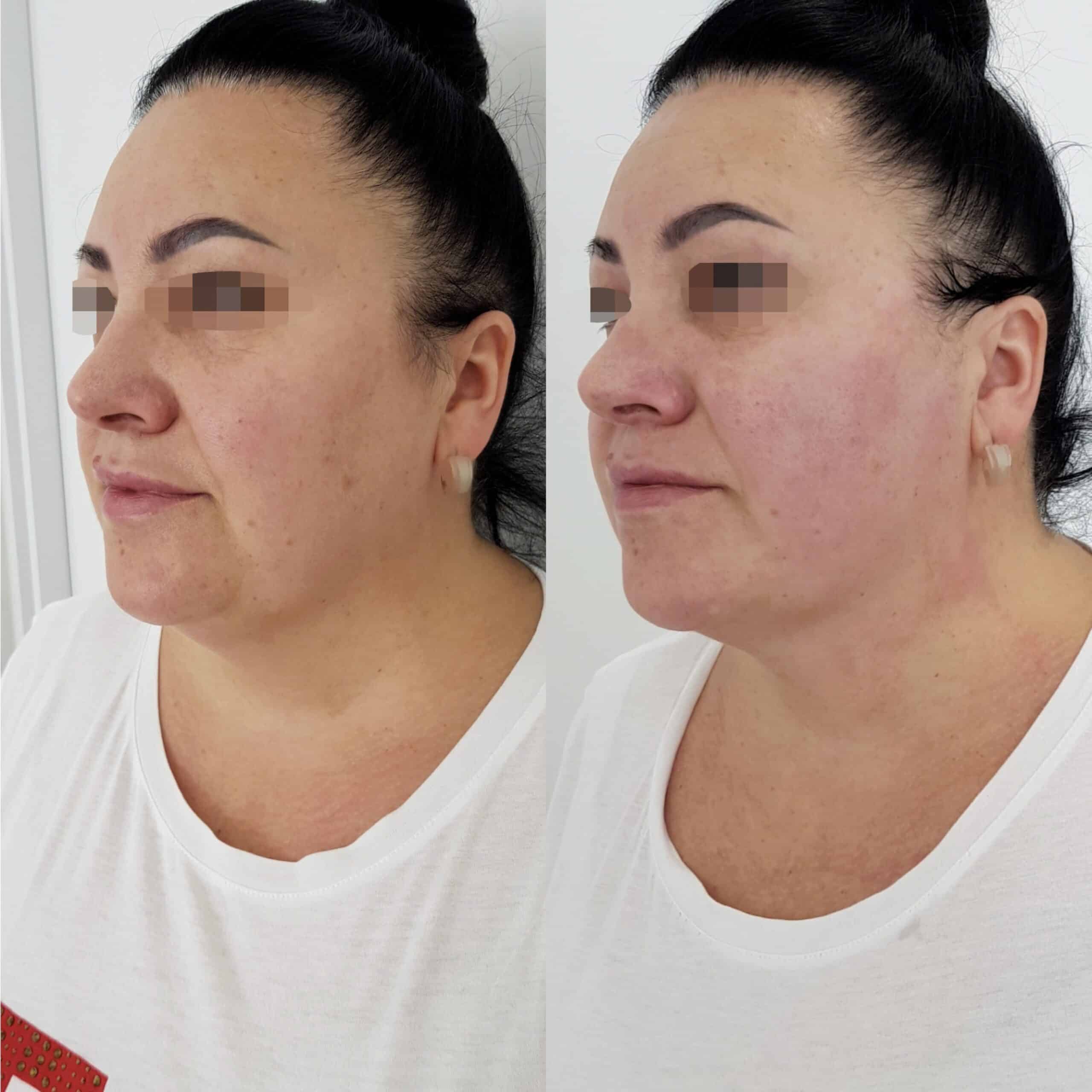 Смас ліфтинг ультраформер: до після