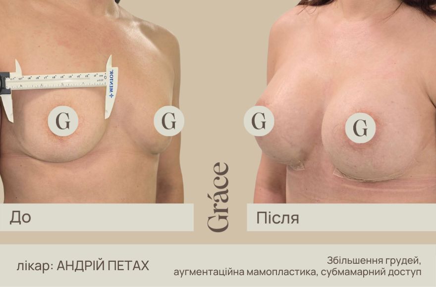 До / після хірурга