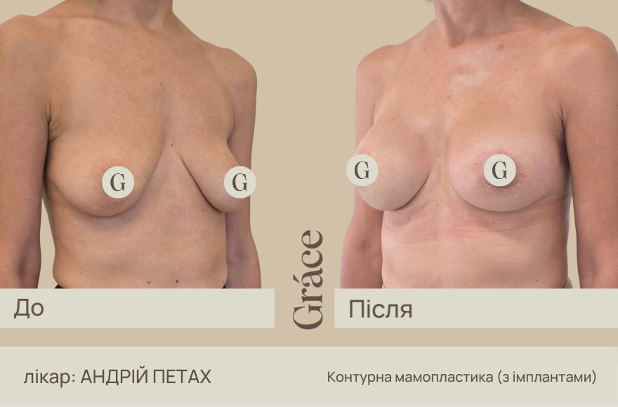 До / після хірурга