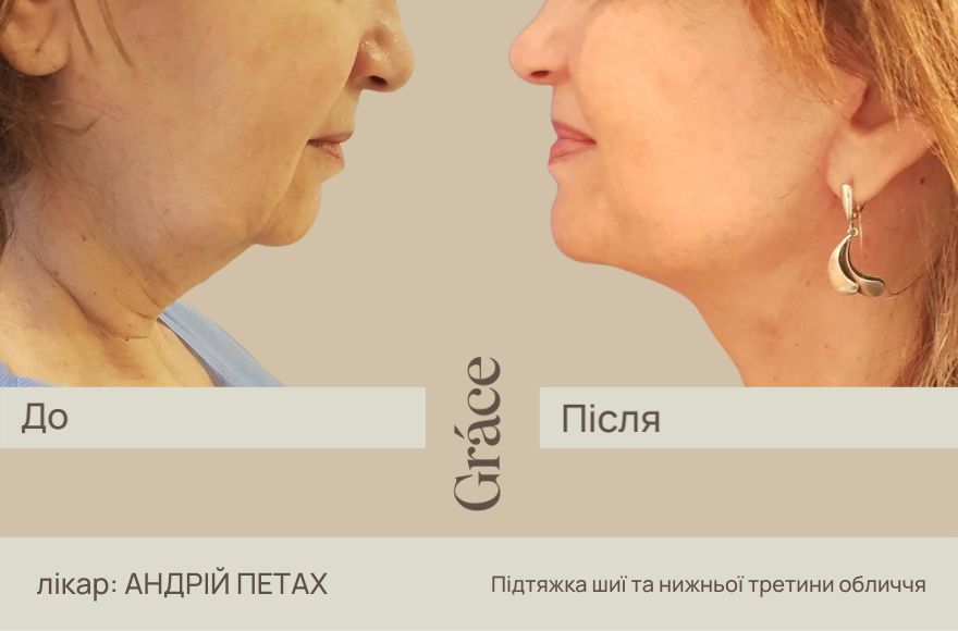 До / після хірурга