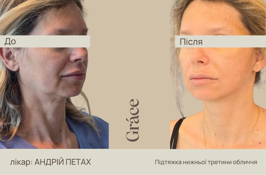 До / після хірурга