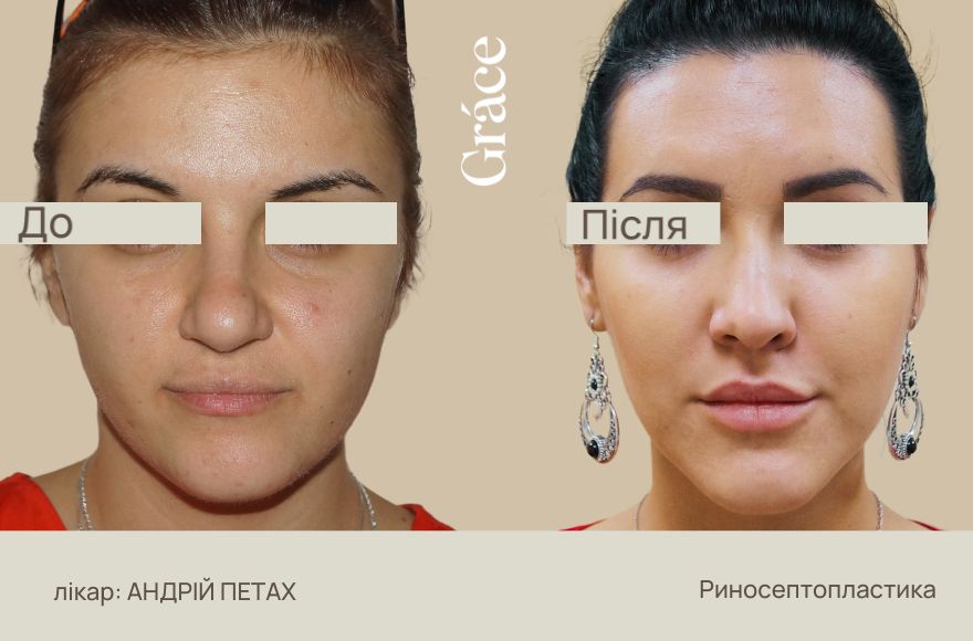 Ринопластика: до після