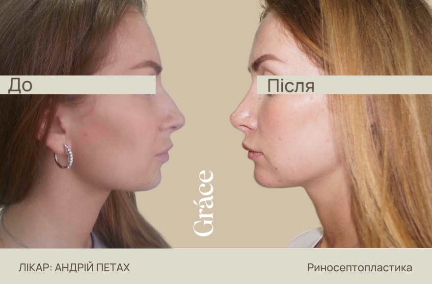 Ринопластика: до після