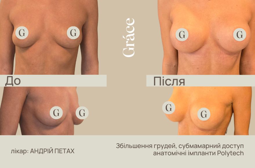 До / після хірурга