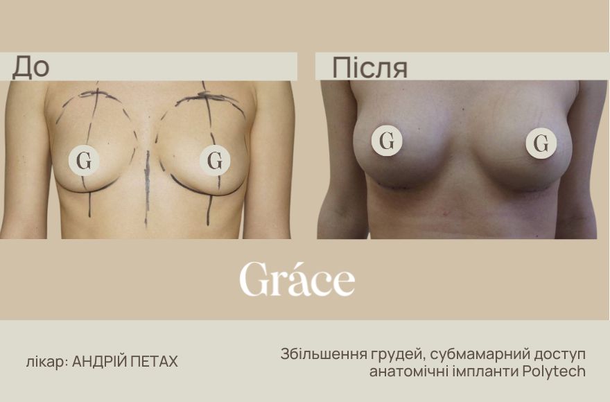 До / після хірурга