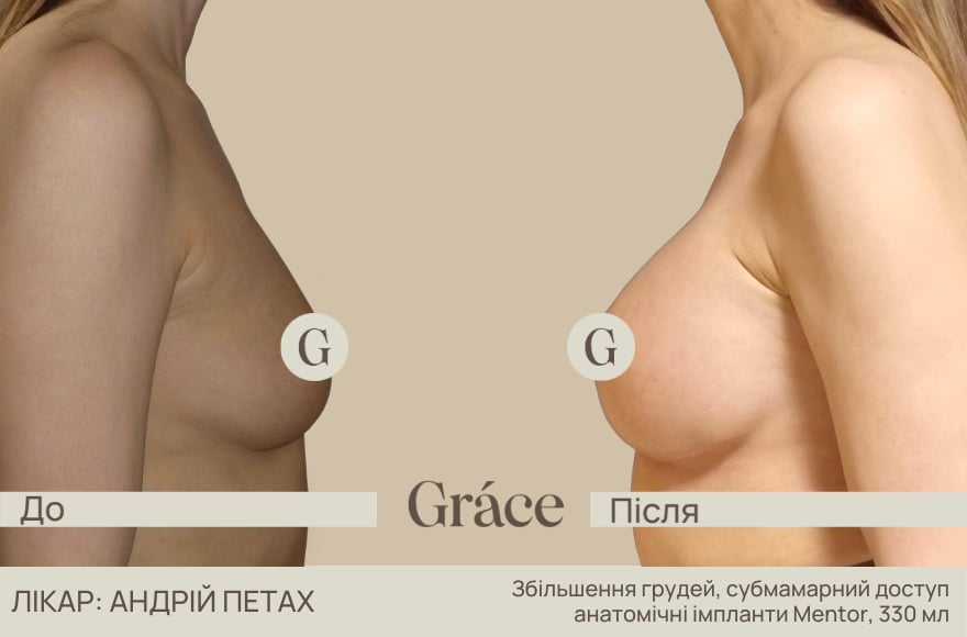 Приклади до / після