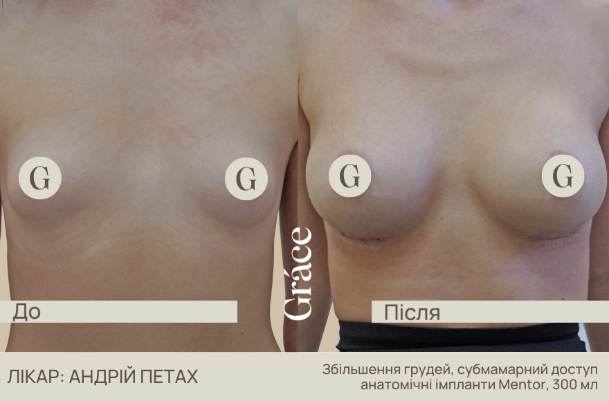 Приклади до / після