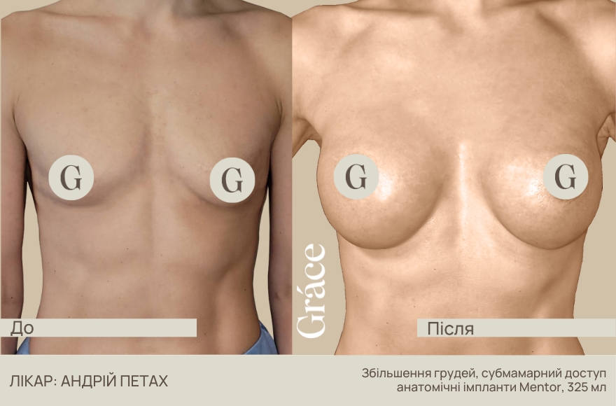 Приклади до / після