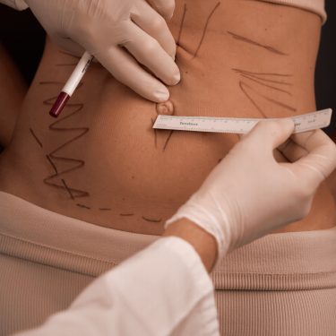 Діастаз: стадії розвитку, як діагностувати у себе і кому потрібне ушивання?
