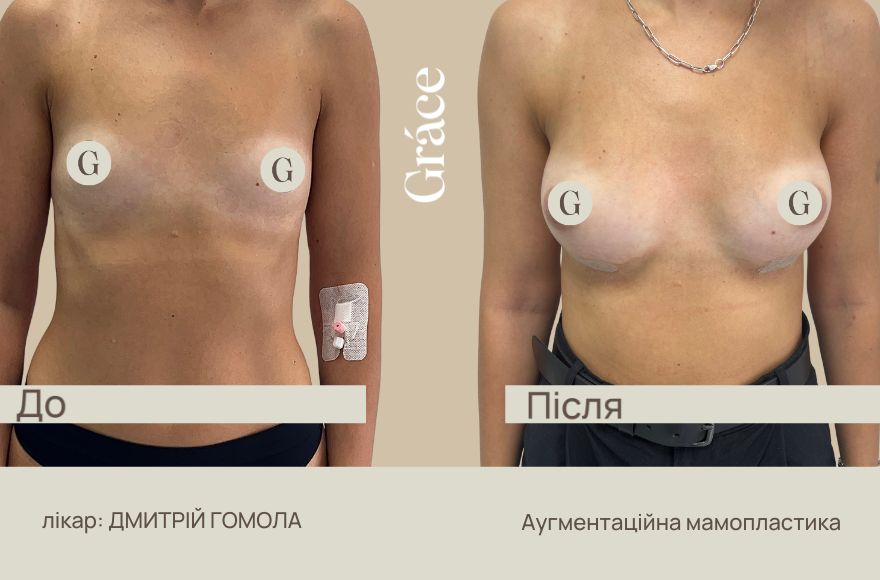 До / після хірурга