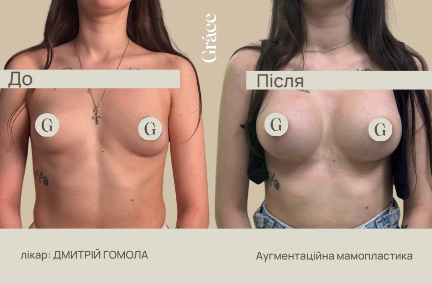 До / після хірурга