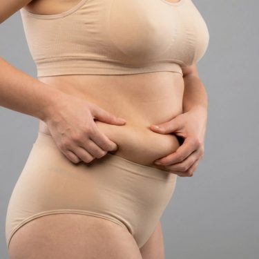 Кожа после похудения: можно ли подтянуть самостоятельно или пластика неизбежна?