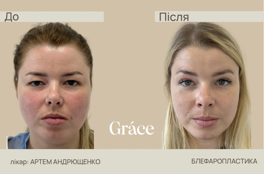 Before / after surgery