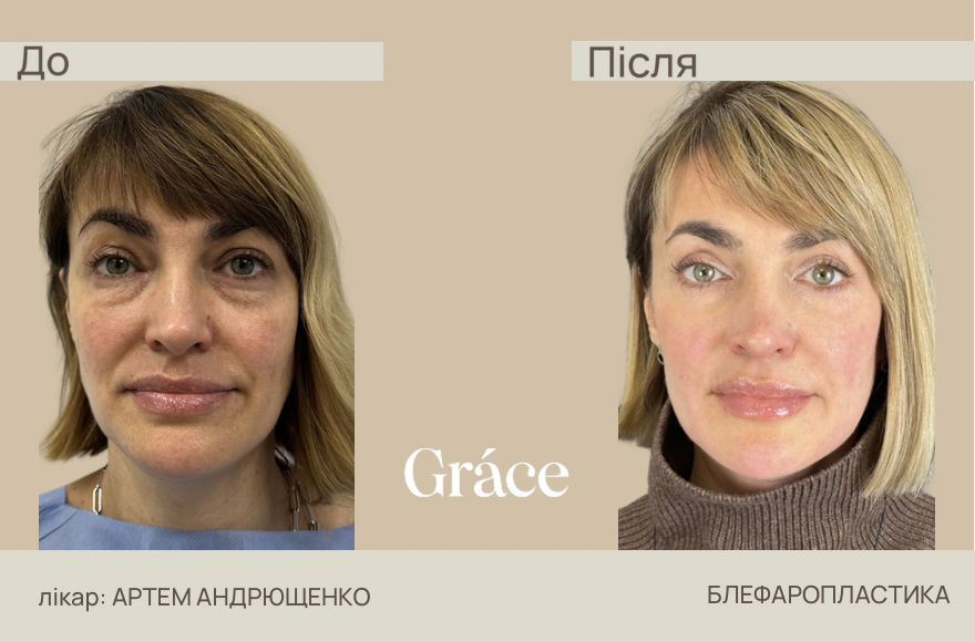Before / after surgery